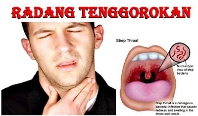 Pakar Kesehatan, Makanan Manis dapat Picu Radang Tenggorokan