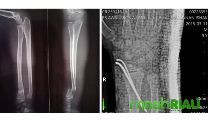 Diduga Malpraktik, Ketua FABEM Riau Akan Polisikan Oknum Dokter di RSUD Teluk Kuantan