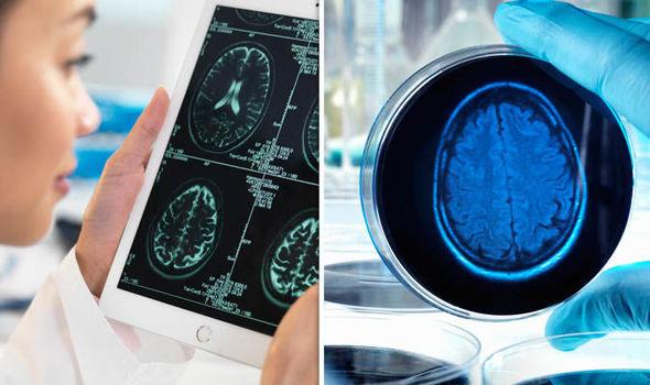 Pacemaker Otak, inovasi terbaru untuk Penyakit Alzheimer