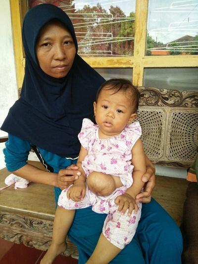 Sedihhh... Menanti Operasi, Usus Bayi 13 Bulan Ini Ada diluar