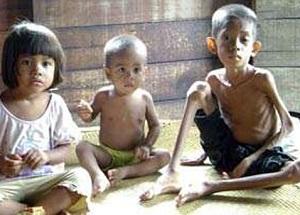 Hal ini juga Menyebabkan Anak Bergizi Buruk