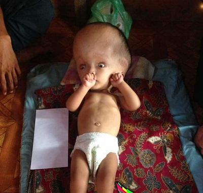 Berharap Bantuan, Asraf Rizklullah Anak Meranti Menderita Penyakit Hidrosefalus