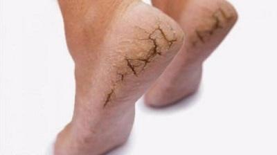 Ini dia Cara Menghilangkan Kapalan Di Kaki