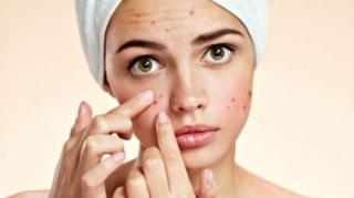 Batasi Konsumsi Susu dan Gula untuk Atasi Jerawat