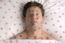 Bisakah Campak Menular pada Mereka yang Telah Divaksin?