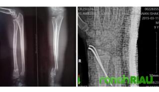 Diduga Malpraktik, Ketua FABEM Riau Akan Polisikan Oknum Dokter di RSUD Teluk Kuantan