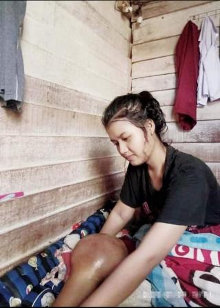 Tak ada biaya, Pemain Voli andalan Sekolah Itu terancam amputasi