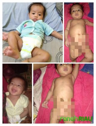 Sosok kecil penderita "Hirschsprung", menanti uluran tangan Dermawan