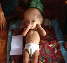 Berharap Bantuan, Asraf Rizklullah Anak Meranti Menderita Penyakit Hidrosefalus
